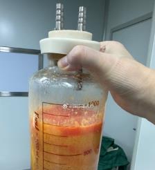 松原水动力吸脂手术要做多久？